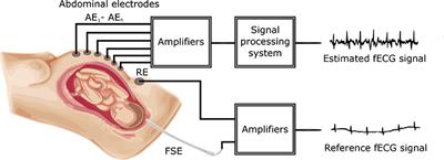 Comparative Effectiveness of ICA and PCA in Extraction of Fetal ECG From Abdominal Signals: Toward Non-invasive Fetal Monitoring